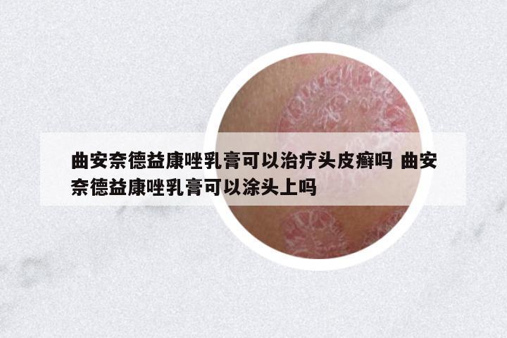 曲安奈德益康唑乳膏可以治療頭皮癬嗎 曲安奈德益康唑乳膏可以涂頭上嗎