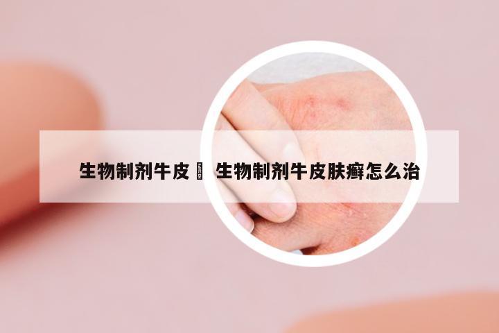 生物制劑牛皮廯 生物制劑牛皮膚癬怎么治