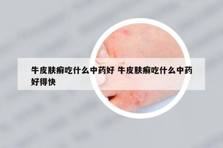 牛皮膚癬吃什么中藥好 牛皮膚癬吃什么中藥好得快