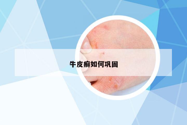 牛皮癬如何鞏固