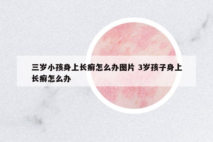 三歲小孩身上長癬怎么辦圖片 3歲孩子身上長癬怎么辦