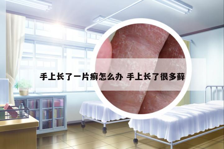 手上長了一片癬怎么辦 手上長了很多蘚