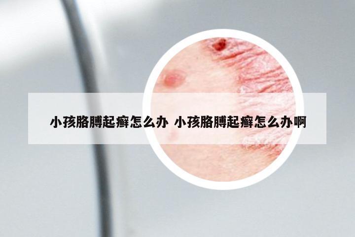 小孩胳膊起癬怎么辦 小孩胳膊起癬怎么辦啊