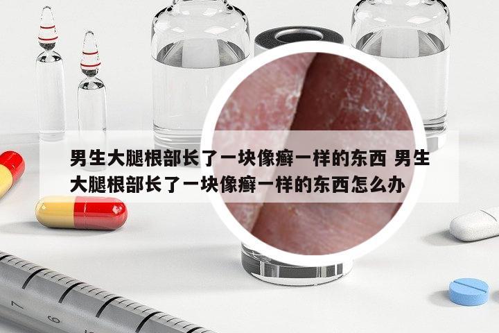 男生大腿根部長(zhǎng)了一塊像癬一樣的東西 男生大腿根部長(zhǎng)了一塊像癬一樣的東西怎么辦