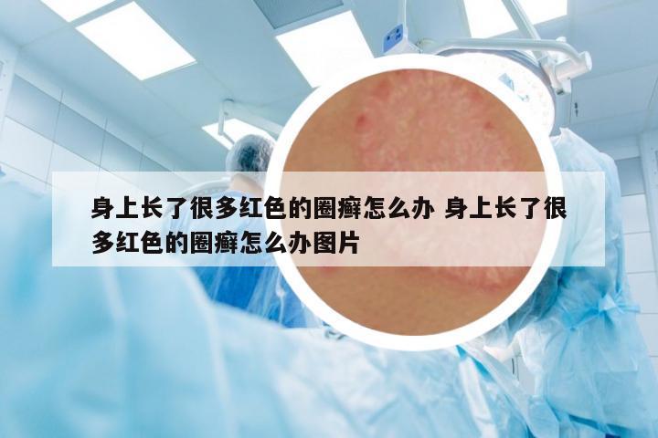 身上長(zhǎng)了很多紅色的圈癬怎么辦 身上長(zhǎng)了很多紅色的圈癬怎么辦圖片