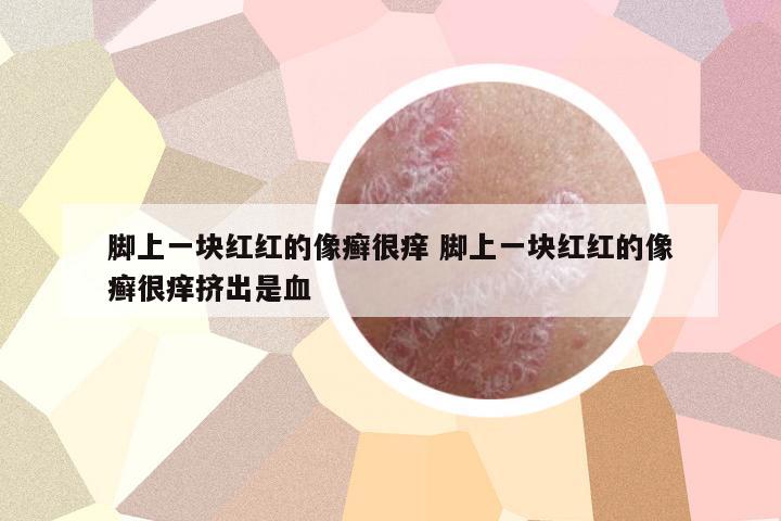 腳上一塊紅紅的像癬很癢 腳上一塊紅紅的像癬很癢擠出是血