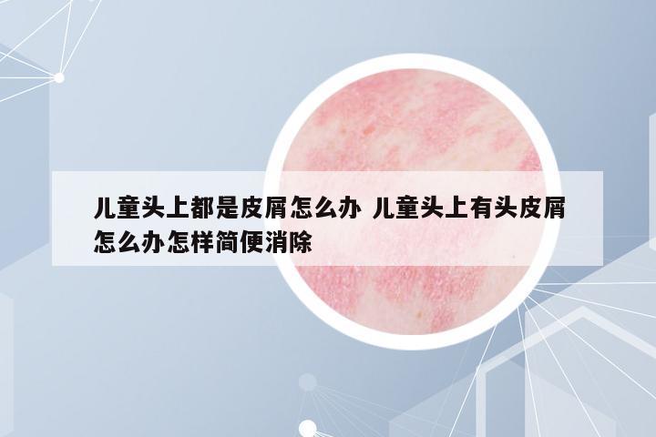 兒童頭上都是皮屑怎么辦 兒童頭上有頭皮屑怎么辦怎樣簡(jiǎn)便消除