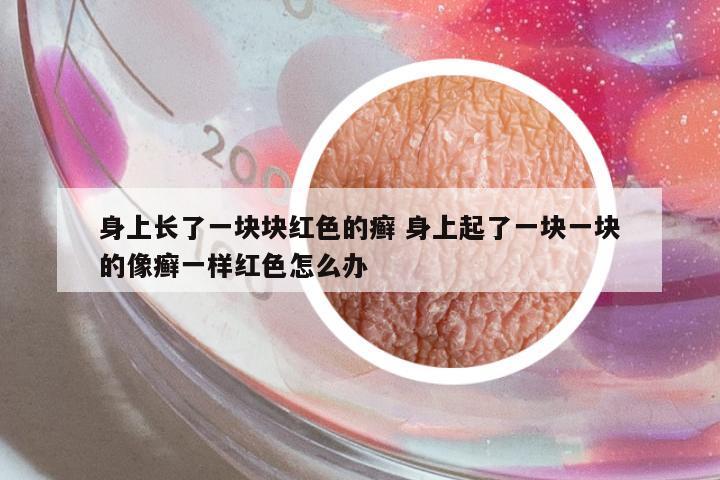 身上長了一塊塊紅色的癬 身上起了一塊一塊的像癬一樣紅色怎么辦