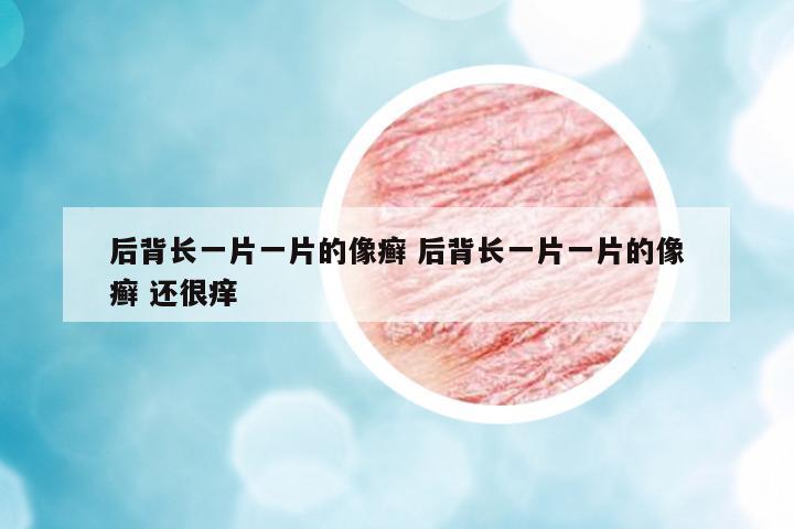 后背長一片一片的像癬 后背長一片一片的像癬 還很癢