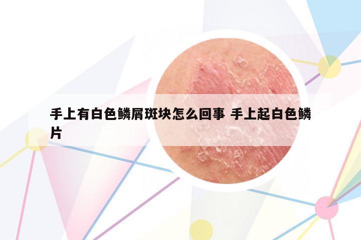 手上有白色鱗屑斑塊怎么回事 手上起白色鱗片
