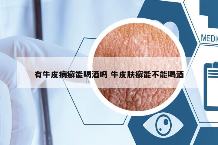有牛皮病癬能喝酒嗎 牛皮膚癬能不能喝酒