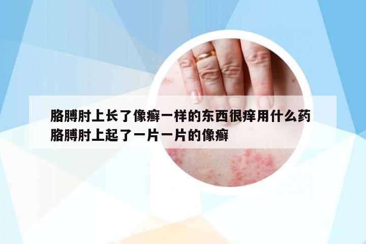 胳膊肘上長(zhǎng)了像癬一樣的東西很癢用什么藥 胳膊肘上起了一片一片的像癬