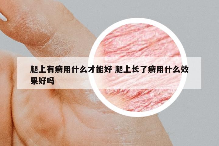 腿上有癬用什么才能好 腿上長了癬用什么效果好嗎
