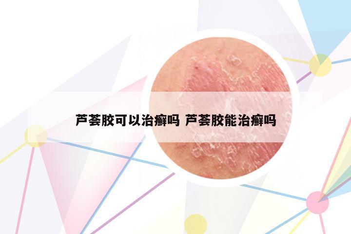 蘆薈膠可以治癬嗎 蘆薈膠能治癬嗎