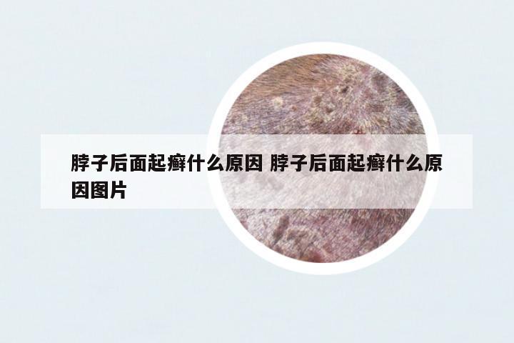 脖子后面起癬什么原因 脖子后面起癬什么原因圖片