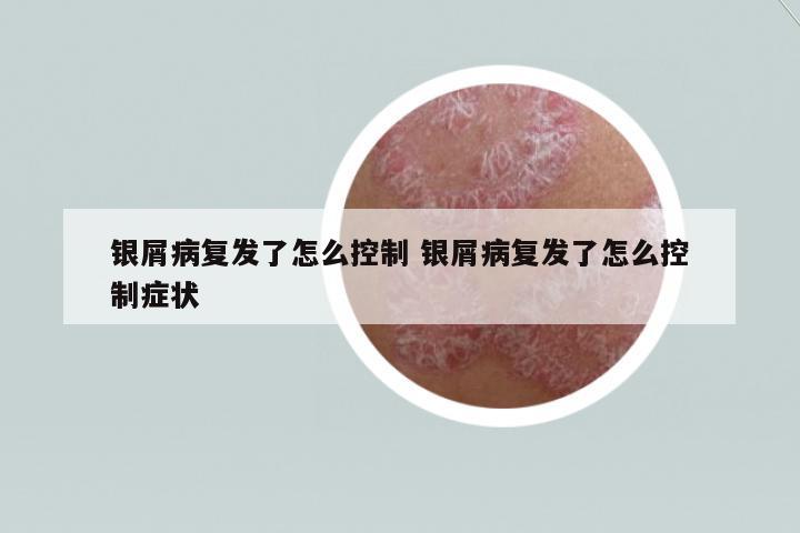銀屑病復(fù)發(fā)了怎么控制 銀屑病復(fù)發(fā)了怎么控制癥狀