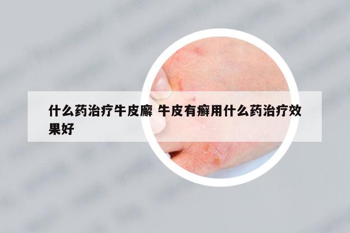 什么藥治療牛皮廨 牛皮有癬用什么藥治療效果好