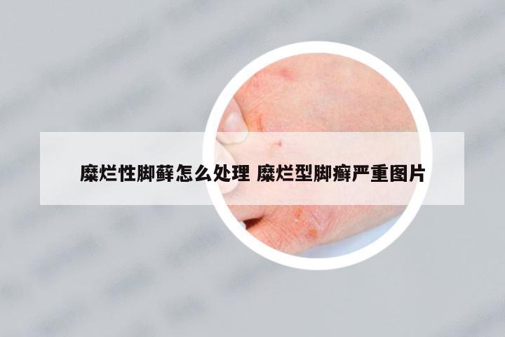 糜爛性腳蘚怎么處理 糜爛型腳癬嚴(yán)重圖片