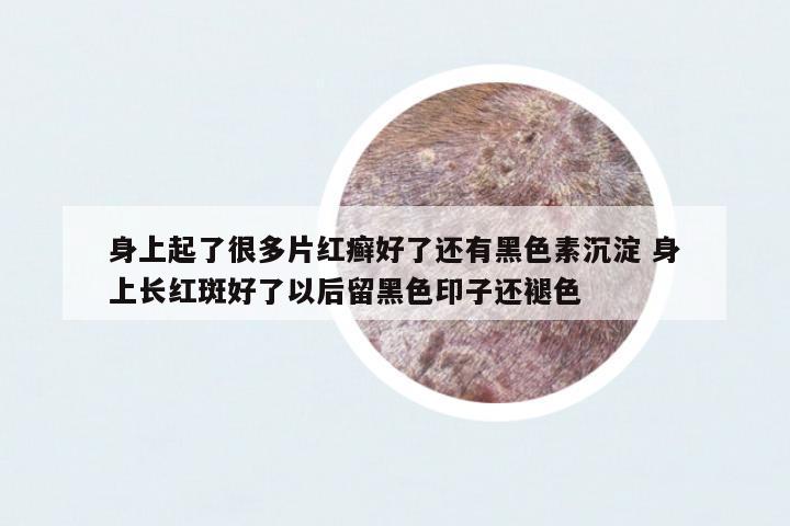 身上起了很多片紅癬好了還有黑色素沉淀 身上長紅斑好了以后留黑色印子還褪色