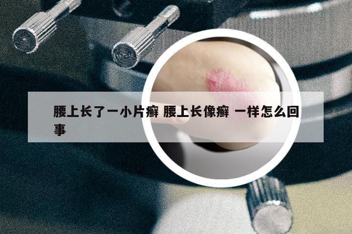 腰上長(zhǎng)了一小片癬 腰上長(zhǎng)像癬 一樣怎么回事