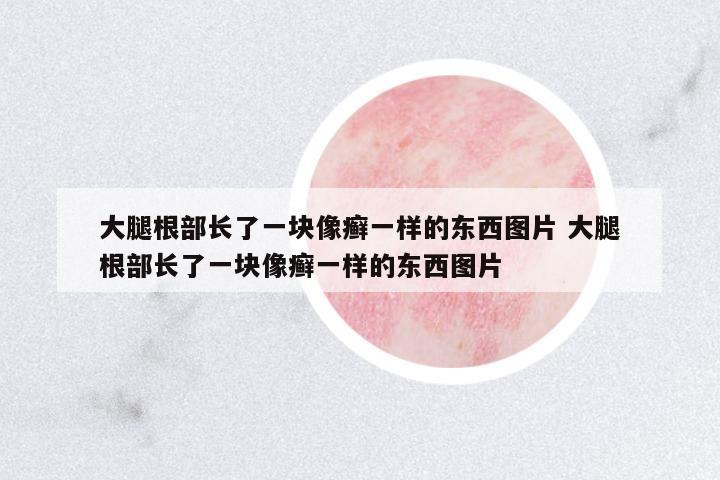 大腿根部長了一塊像癬一樣的東西圖片 大腿根部長了一塊像癬一樣的東西圖片