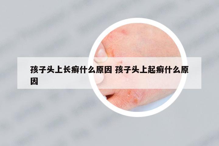 孩子頭上長(zhǎng)癬什么原因 孩子頭上起癬什么原因