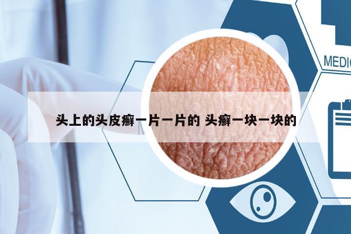 頭上的頭皮癬一片一片的 頭癬一塊一塊的