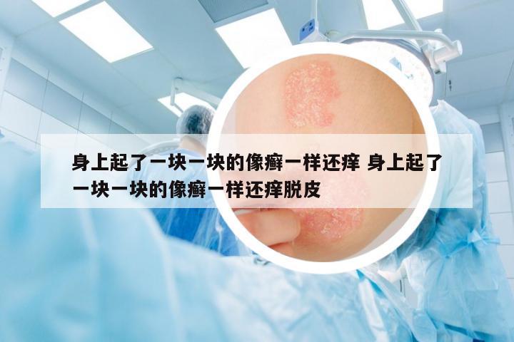 身上起了一塊一塊的像癬一樣還癢 身上起了一塊一塊的像癬一樣還癢脫皮