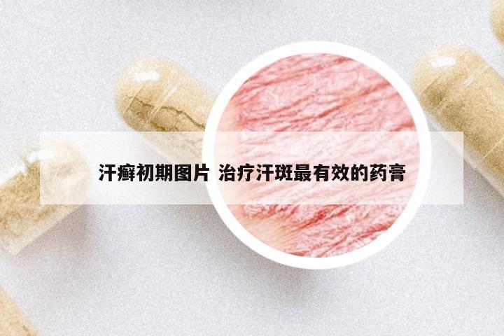 汗癬初期圖片 治療汗斑最有效的藥膏