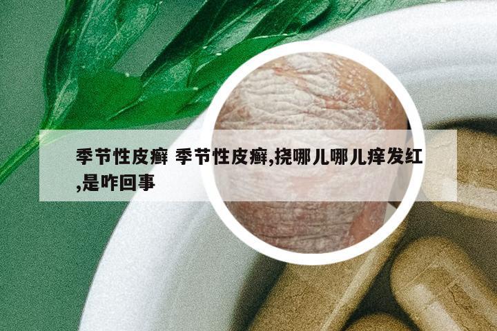 季節(jié)性皮癬 季節(jié)性皮癬,撓哪兒哪兒癢發(fā)紅,是咋回事