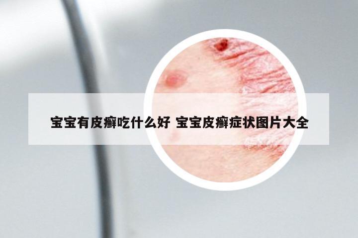 寶寶有皮癬吃什么好 寶寶皮癬癥狀圖片大全