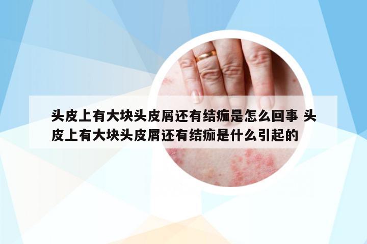 頭皮上有大塊頭皮屑還有結(jié)痂是怎么回事 頭皮上有大塊頭皮屑還有結(jié)痂是什么引起的