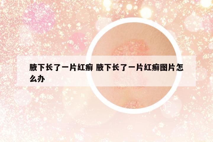 腋下長了一片紅癬 腋下長了一片紅癬圖片怎么辦