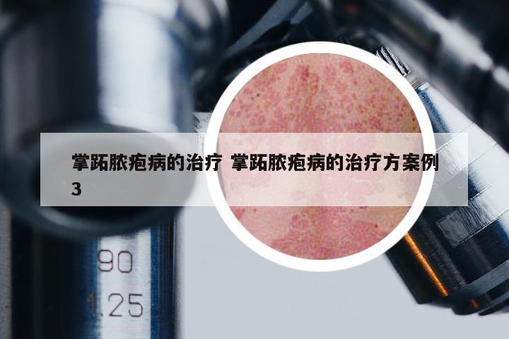 掌跖膿皰病的治療 掌跖膿皰病的治療方案例3