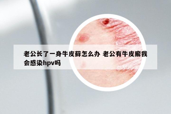 老公長了一身牛皮蘚怎么辦 老公有牛皮廨我會感染hpv嗎