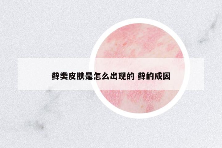 蘚類皮膚是怎么出現(xiàn)的 蘚的成因