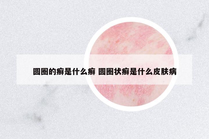 圓圈的癬是什么癬 圓圈狀癬是什么皮膚病