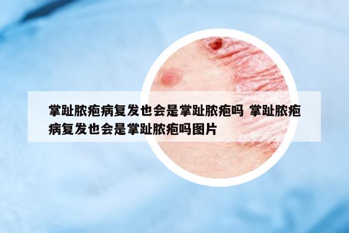 掌趾膿皰病復(fù)發(fā)也會(huì)是掌趾膿皰嗎 掌趾膿皰病復(fù)發(fā)也會(huì)是掌趾膿皰嗎圖片