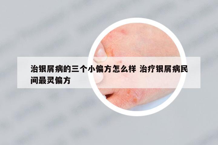 治銀屑病的三個小偏方怎么樣 治療銀屑病民間最靈偏方
