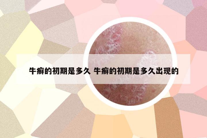 牛癬的初期是多久 牛癬的初期是多久出現(xiàn)的