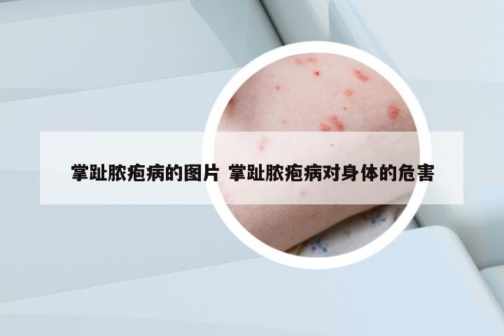 掌趾膿皰病的圖片 掌趾膿皰病對(duì)身體的危害