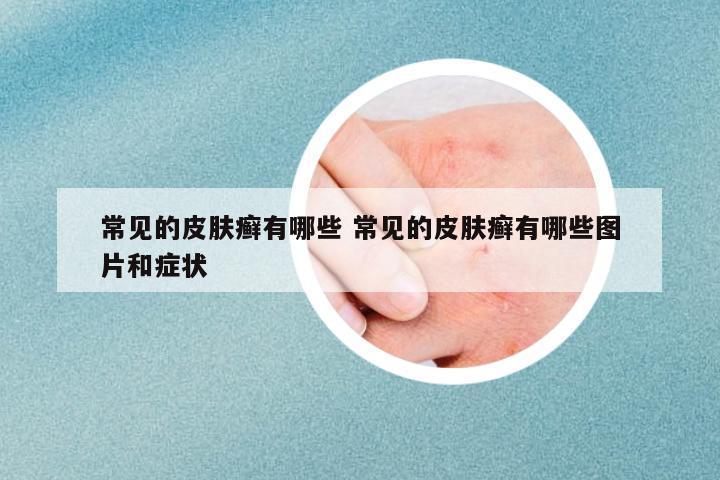 常見(jiàn)的皮膚癬有哪些 常見(jiàn)的皮膚癬有哪些圖片和癥狀