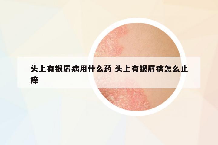頭上有銀屑病用什么藥 頭上有銀屑病怎么止癢