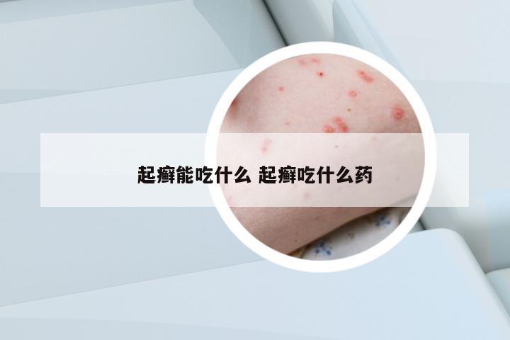 起癬能吃什么 起癬吃什么藥