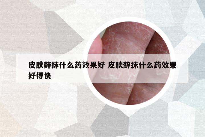 皮膚蘚抹什么藥效果好 皮膚蘚抹什么藥效果好得快