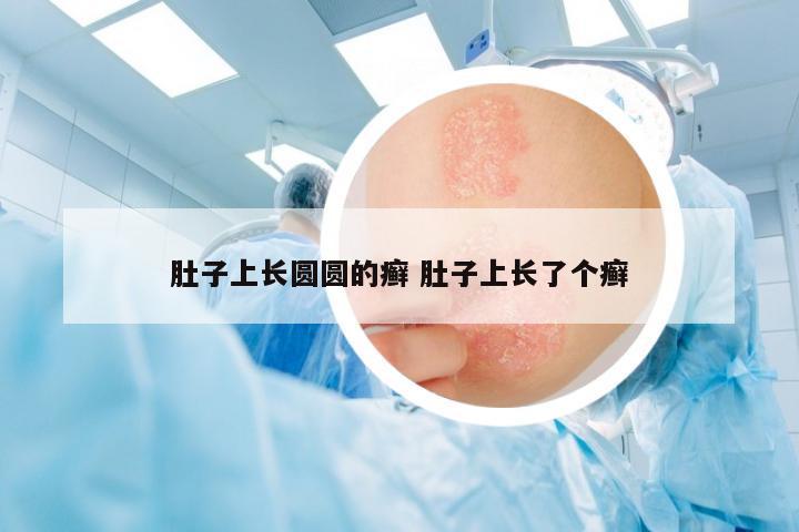 肚子上長圓圓的癬 肚子上長了個(gè)癬