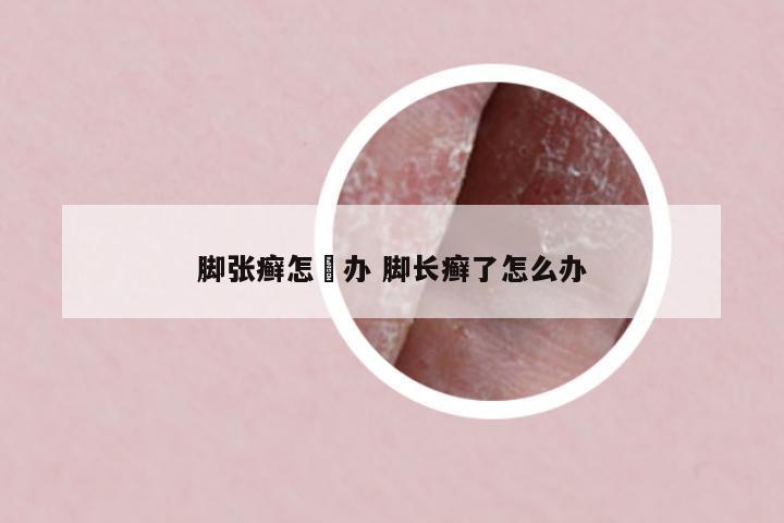 腳張癬怎麼辦 腳長癬了怎么辦