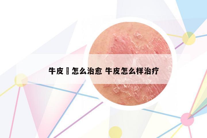 牛皮廯怎么治愈 牛皮怎么樣治療