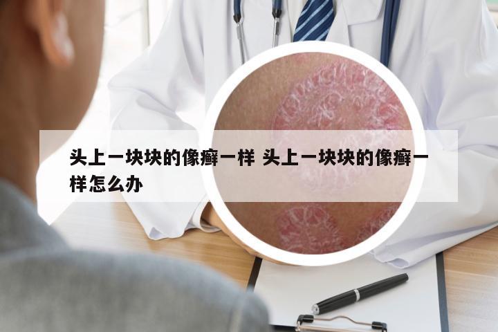 頭上一塊塊的像癬一樣 頭上一塊塊的像癬一樣怎么辦