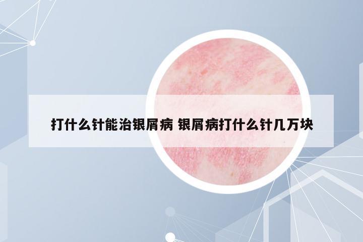 打什么針能治銀屑病 銀屑病打什么針幾萬塊